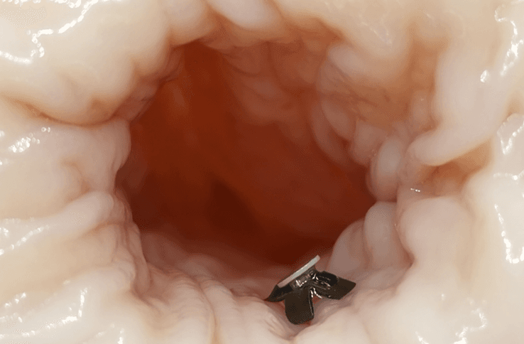 Microrobot for Gastrointestinal Diseases